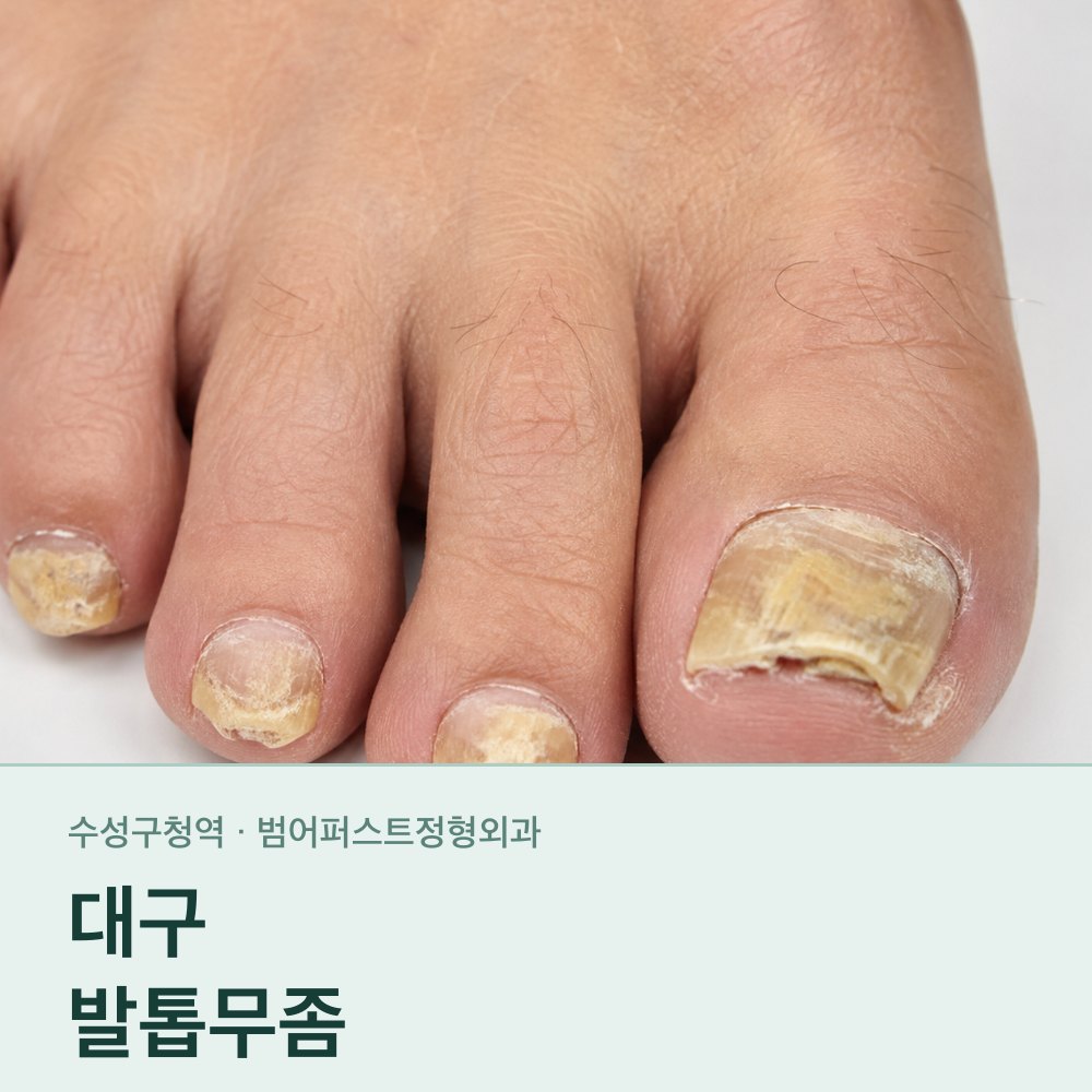 대구발톱무좀 — 왜 바르는 약만으로는 잘 낫지 않는가