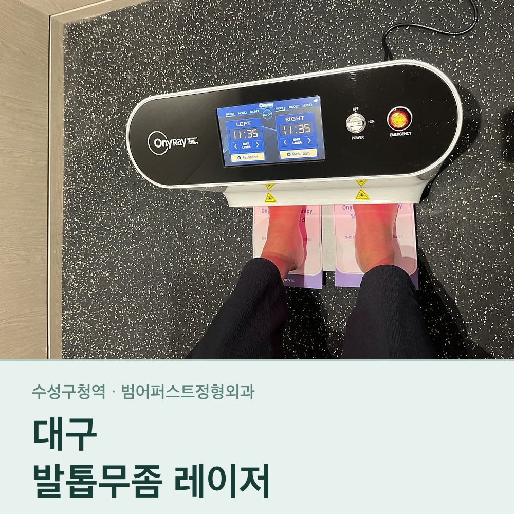 대구발톱무좀레이저 — 오니레이 레이저는 어떤 장비인가