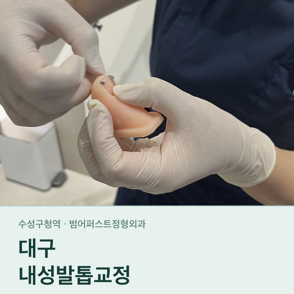 대구내성발톱교정 — 오니콕스 와이어로 발톱 모양을 잡는 방법