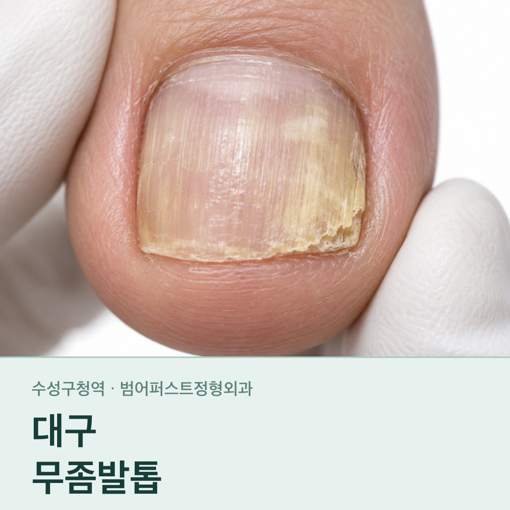 대구무좀발톱 — 누렇고 두꺼워진 발톱, 어디까지가 곰팡이인가